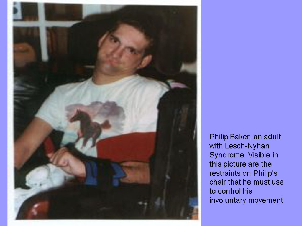 Philip Baker, an adult with Lesch-Nyhan Syndrome. Visible in this picture are the restraints